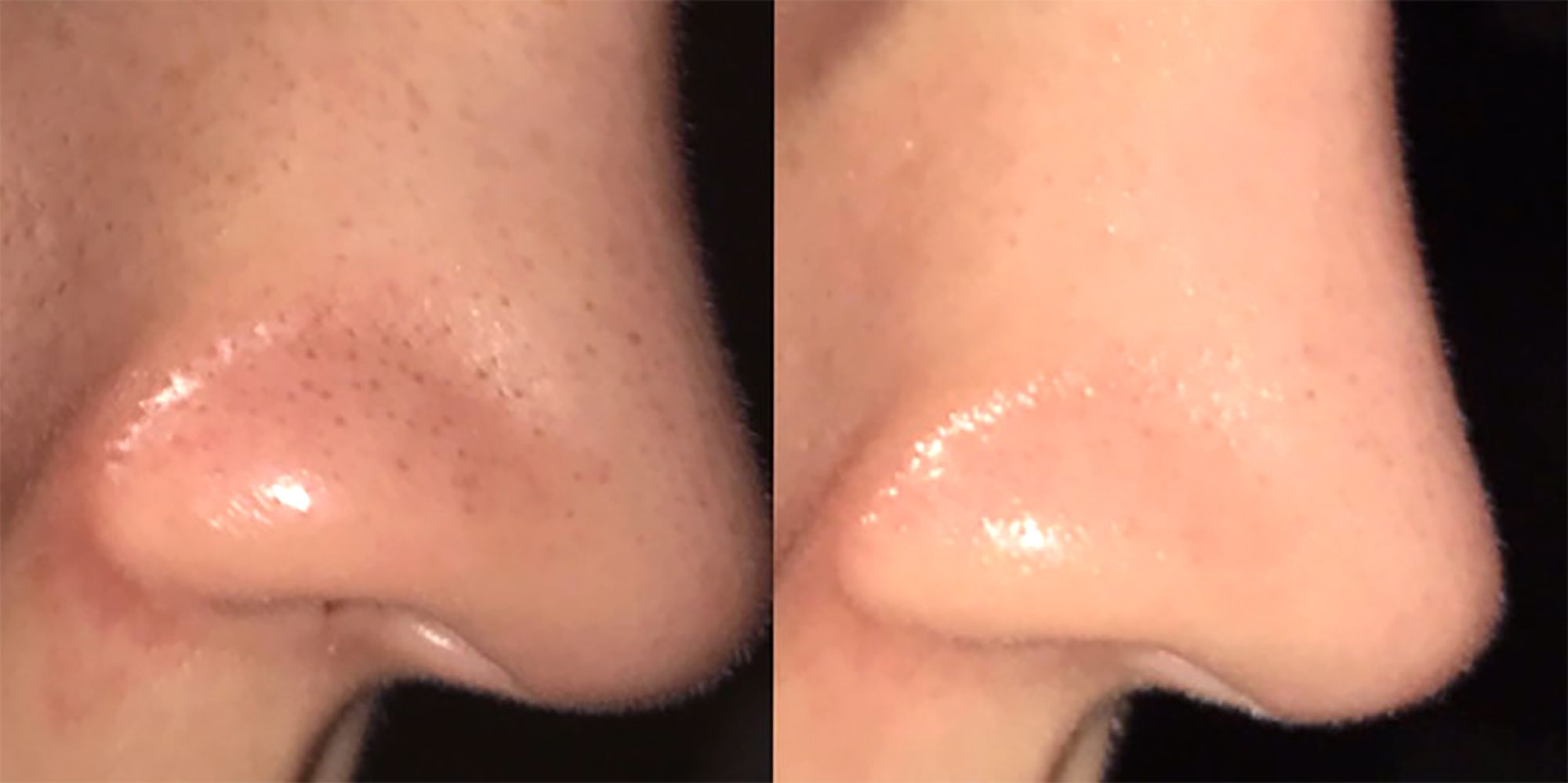 Blackhead Baking Soda