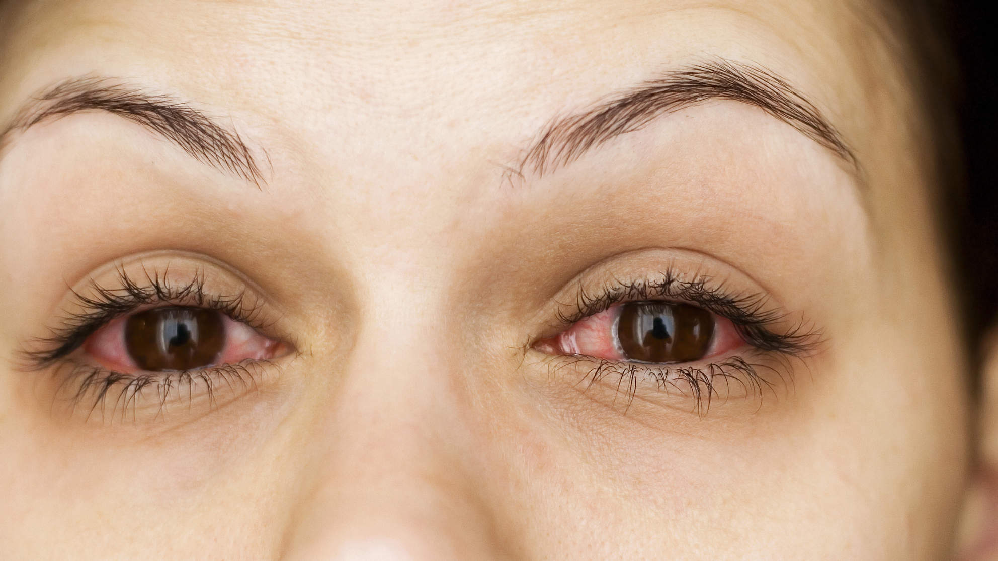 Eyelash Extensions Complications