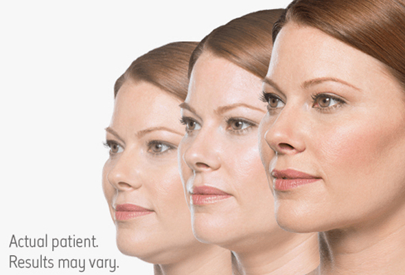 Kybella Injections